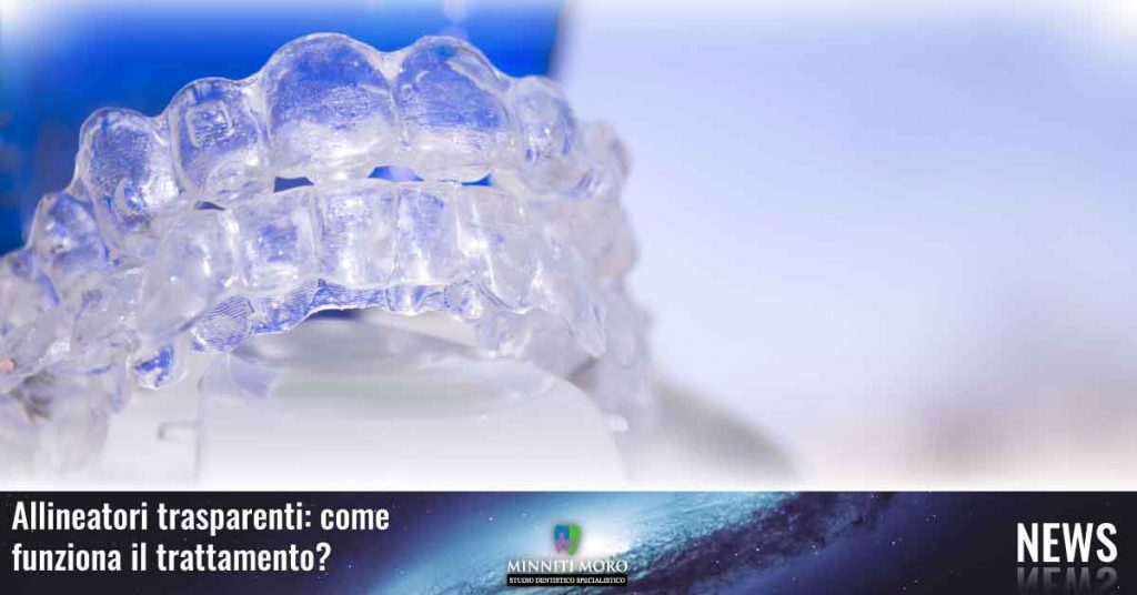 Allineatori trasparenti: come funzionano?
