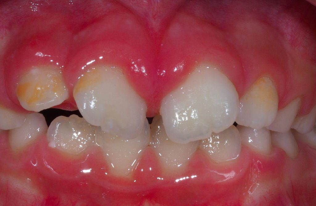 Studio Dentistico Specialistico Minniti Moro | Apparecchio trasparente