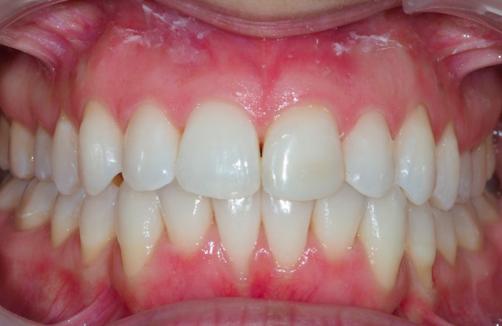 Studio Dentistico Specialistico Minniti Moro | Apparecchio trasparente