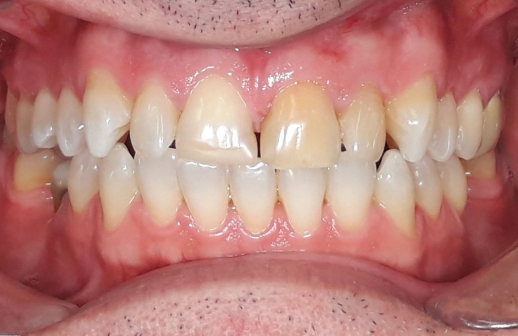 Studio Dentistico Specialistico Minniti Moro | Faccette dentali