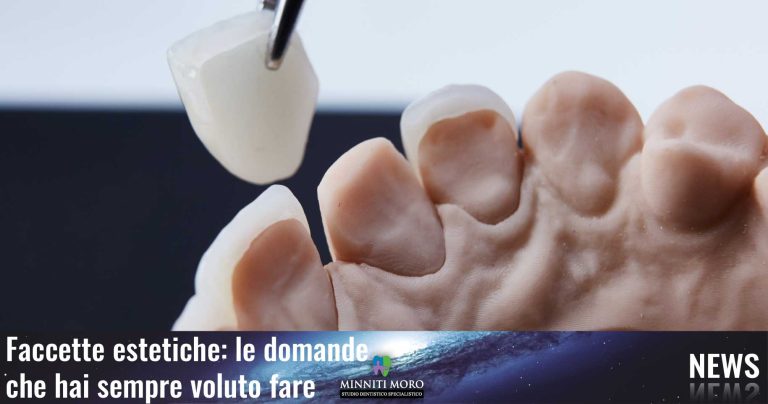 Blog 2 Faccette estetiche: le tue domande