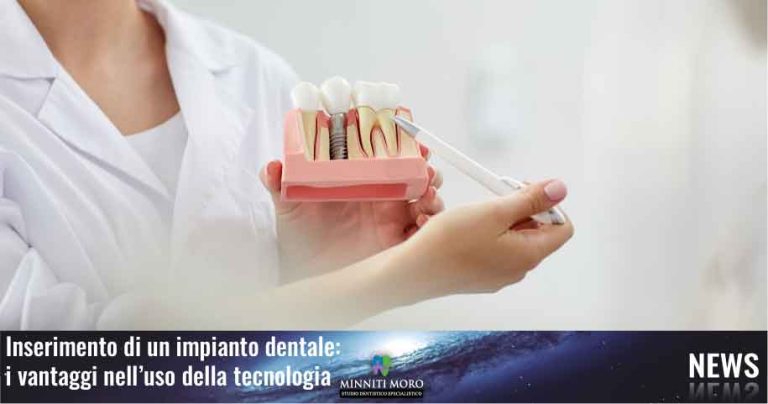 Blog 3 Inserimento impianto dentale: i vantaggi della tecnologia