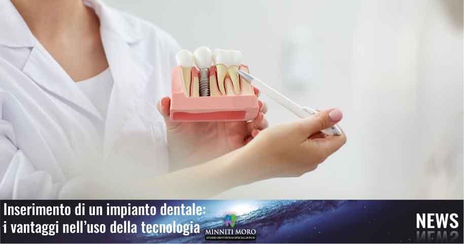 Inserimento di un impianto dentale 8 Inserimento impianto dentale: i vantaggi della tecnologia
