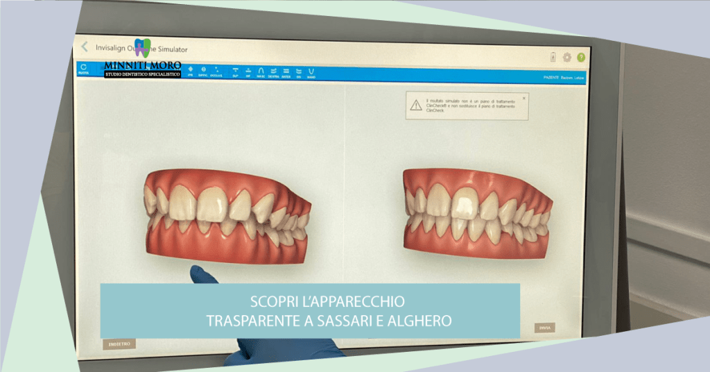 Studio Dentistico Minniti Moro: Apparecchi Trasparenti a Sassari e Alghero 2 Studio Dentistico Minniti Moro: l’apparecchio trasparente a Sassari e Alghero