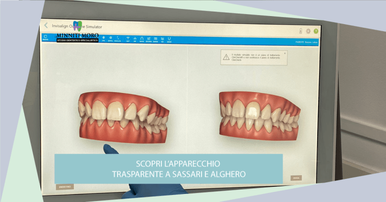 Blog 17 Studio Dentistico Minniti Moro: l’apparecchio trasparente a Sassari e Alghero
