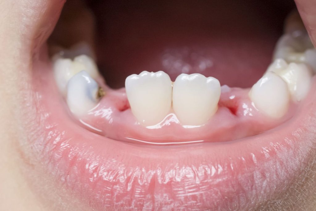 Quanti sono i denti da latte e come prendersene cura 2 Quanti sono i denti da latte e come prendersene cura