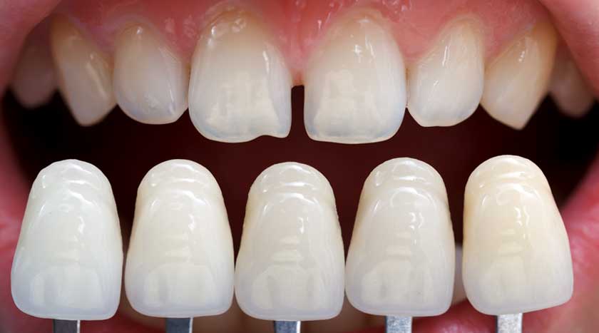 Faccette dentali estetiche 9 Faccette dentali estetiche a Sassari e Alghero