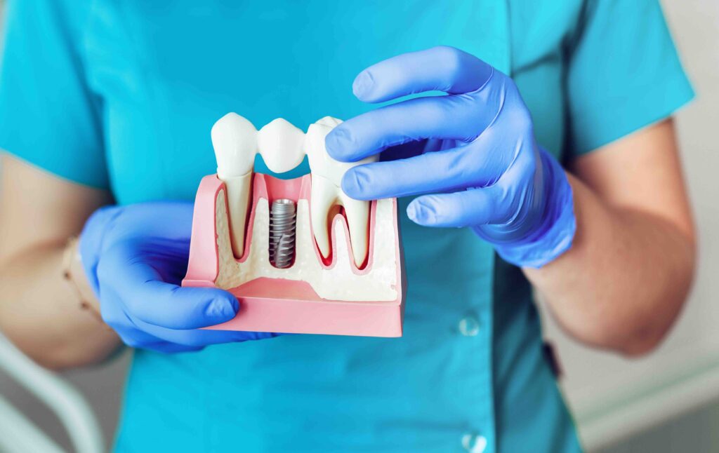 Impianti dentali con poco osso 1 Impianti dentali con poco osso