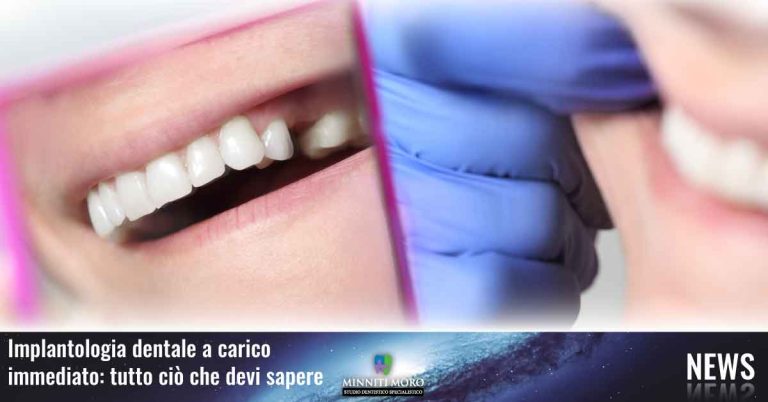 Blog 16 Cosa sapere sull'implantologia a carico immediato