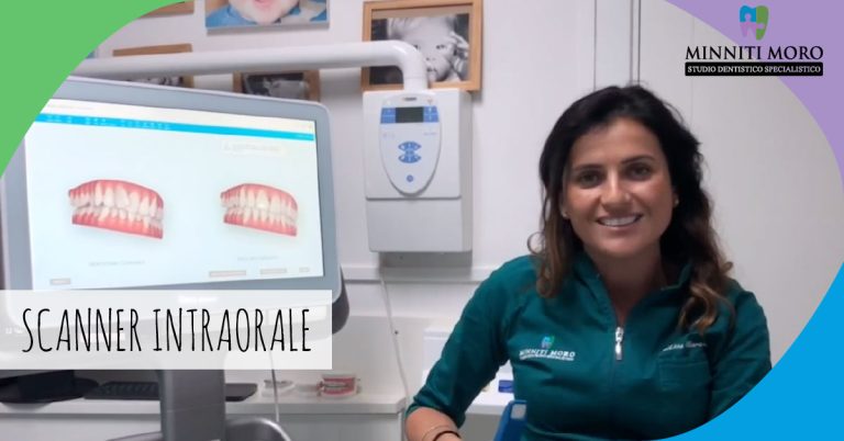Blog 11 Scanner intraorale: la tecnologia per le impronte digitali