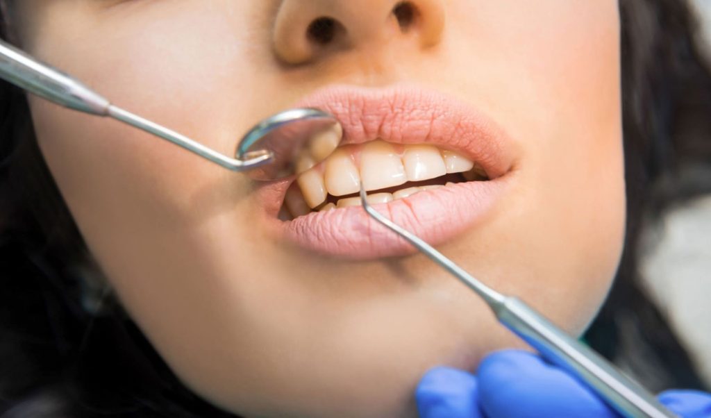 A cosa porta una carie dentale non curata? 1 Carie dentale non curata