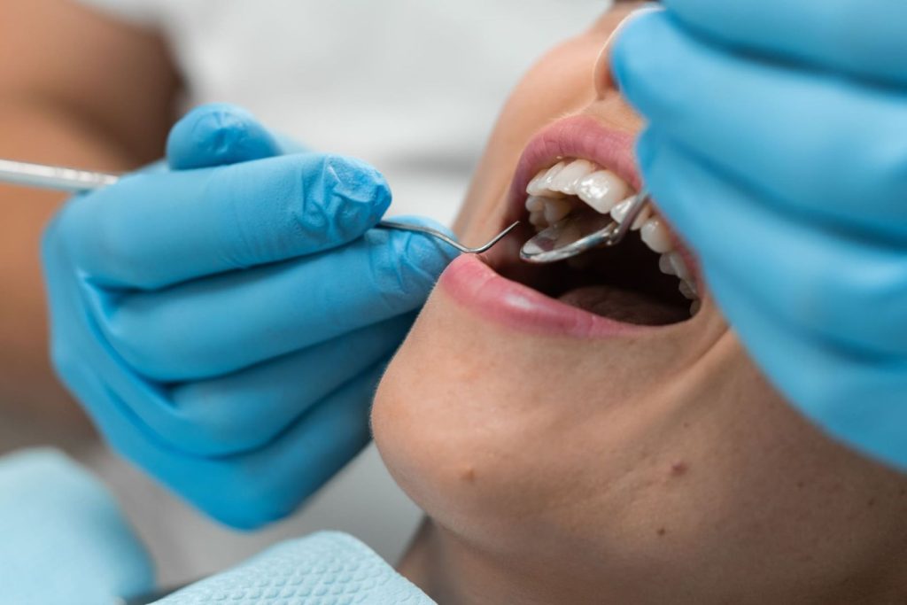 A cosa porta una carie dentale non curata? 2 Carie dentale non curata